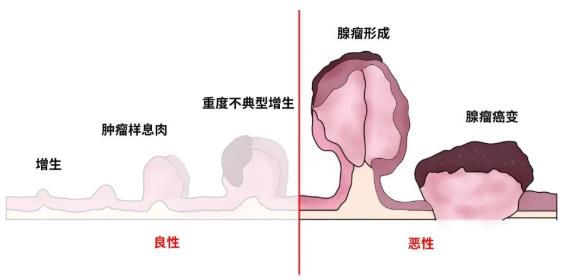 篩查消化道(dào)早癌，胃腸鏡檢查是“金手段”！