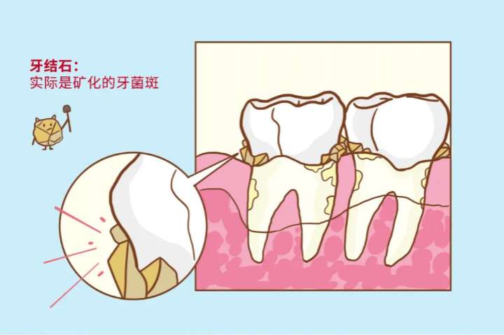 科普|洗牙到底會不會對(duì)牙齒造成(chéng)危害