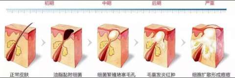 痘痘，痤瘡反複發(fā)作，怎麼(me)辦？