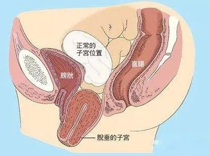 子宮脫垂，中國(guó)女性發(fā)病率高達1/4，301專家想要免費治！